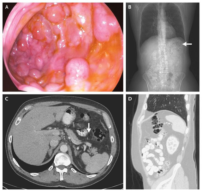 Pneumatosis Intestinalis