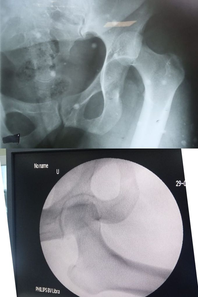 Pic 1-Case of posterior Hip Dx ( Right Hip Joint )