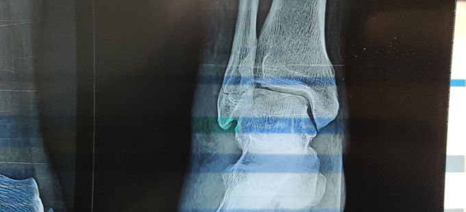Fracture Lateral Malleolus
