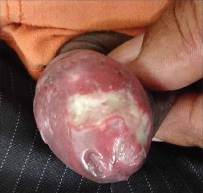 Multiple shallow ulcers with undermined edges and indurated base over the glans penis of a 55 year-old-man