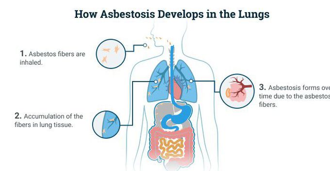 Asbestosis