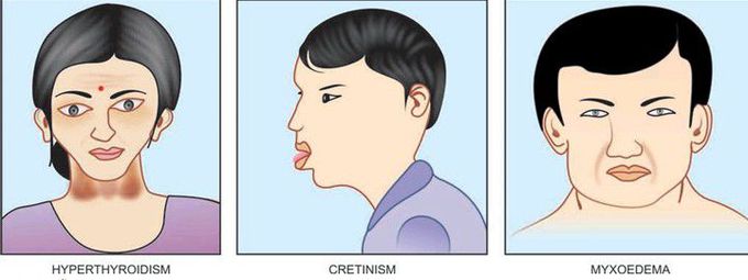 Thyroid dysfunction appearances