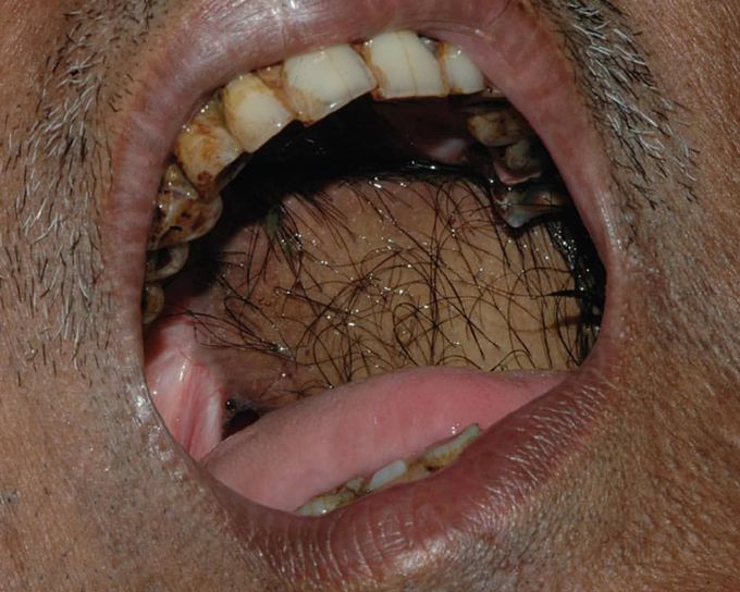 Here is an interesting case of an intraoral presence of hair! 