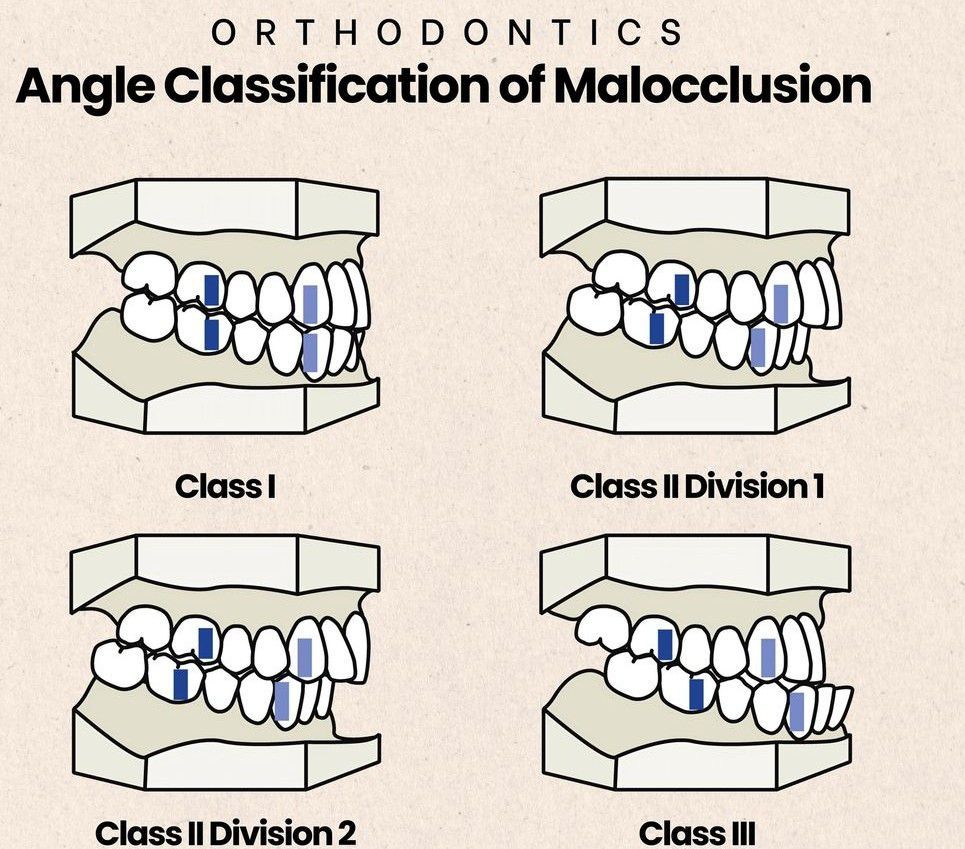 Angle's classification: Class II, Division 1