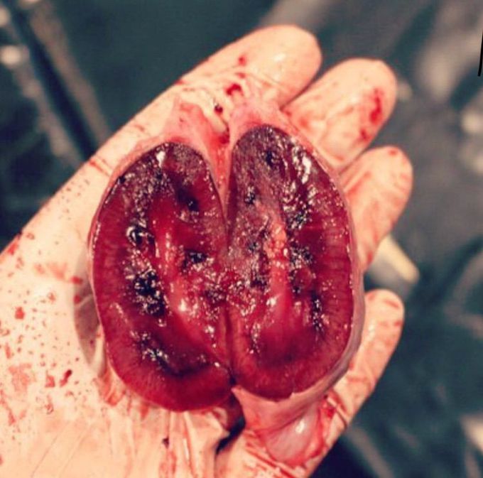 Kidney