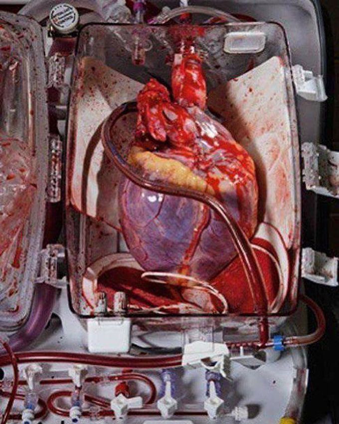 Heart before transplant