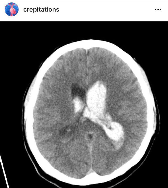 Primary Intraventricular Hemorrhage (CT)