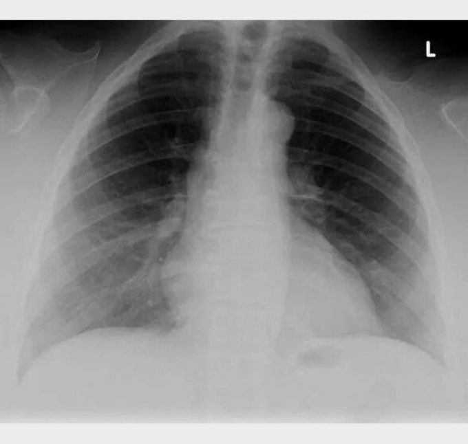 Identify the anatomical abnormality