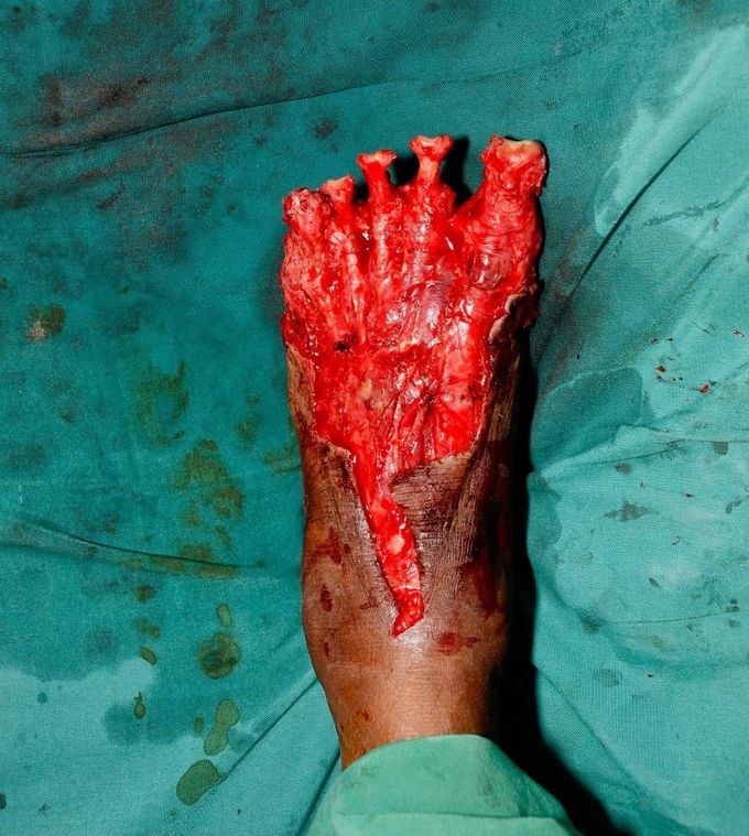 Severe foot injury