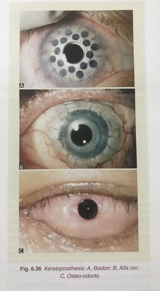 Disease of Cornea : Keratoprosthesis