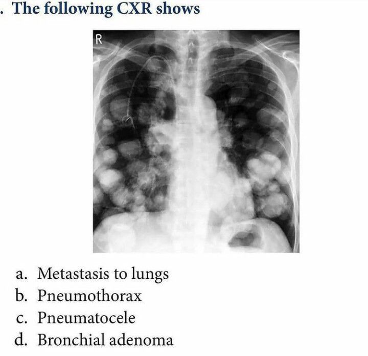 Chest Xray - Medizzy