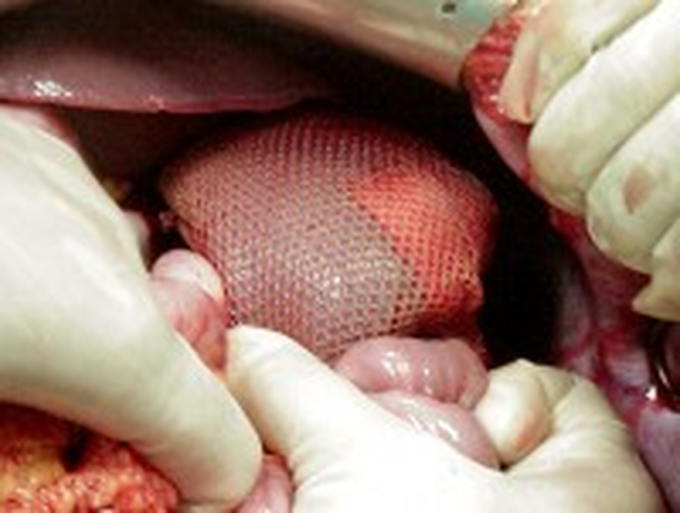SplenorrhaphySuturing the spleen and non-removal:• Performed approximately 6% of the time (anything new in adult splenic ruptures)
• Grade 3 spleen injury - mesh splenorrhaphy