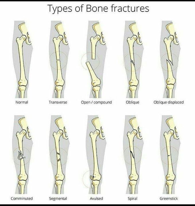 Types of Bone Fractures