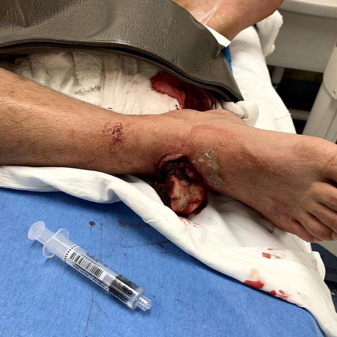 Dislocation of ankle