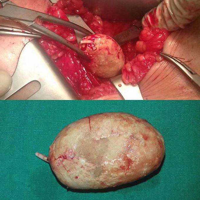 Bladder stone