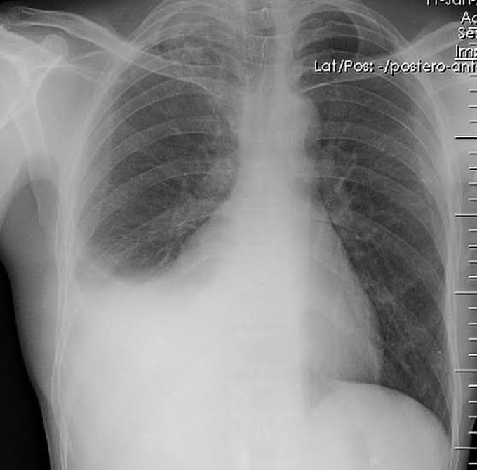 Pleural effusion