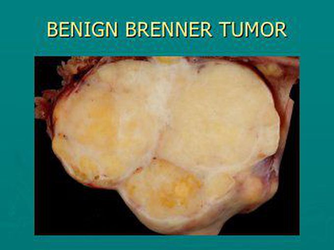 Causeof Brenner tumor