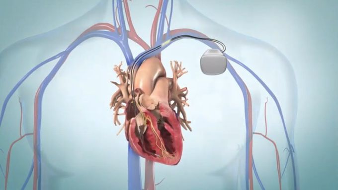 Artificial cardiac pacemaker