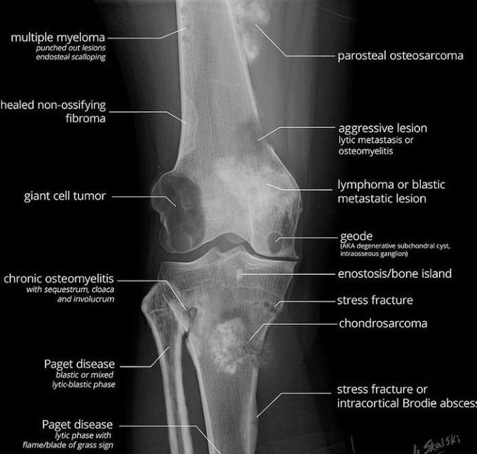 Bone Tumors above 30