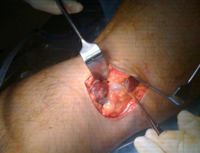 Popliteal cyst