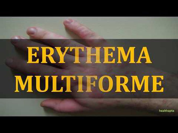 Pathology of Erythema Multiforme.