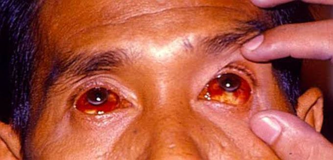 Conjunctival suffusion