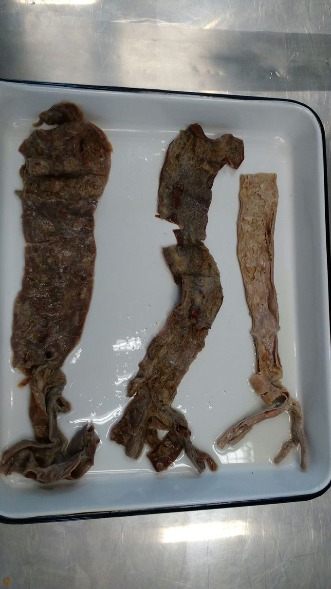Ateroesclerosis