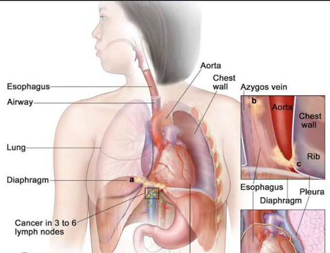 Cause of Plummer-Vinson syndrome