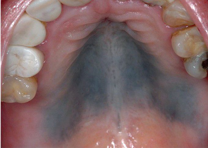 Hydroxychloroquine Pigmentation.