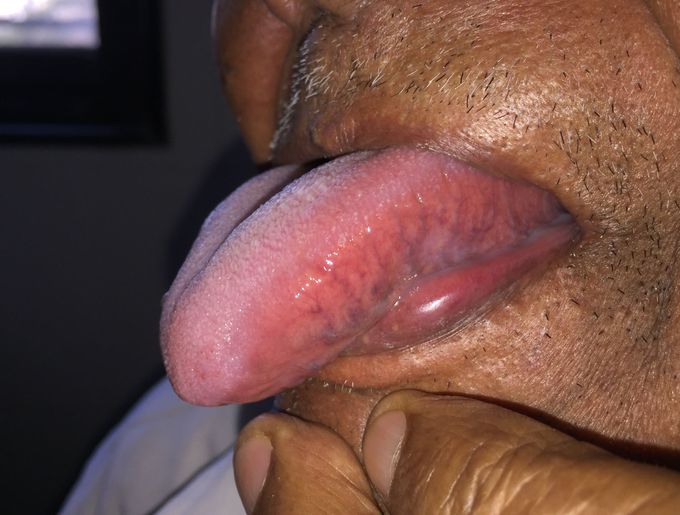 Oral carcinoma