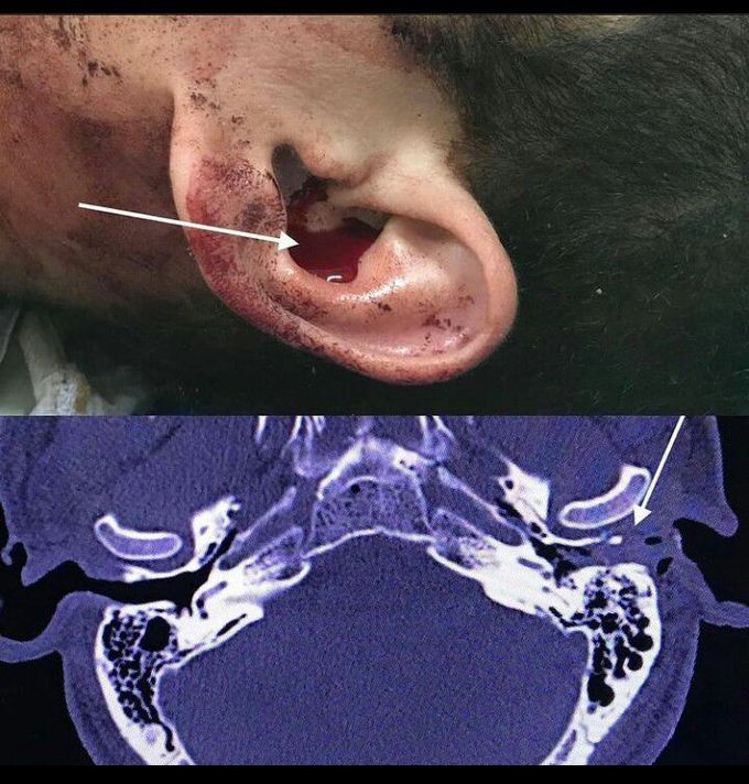 Glenoid fossa fracture and otorragy