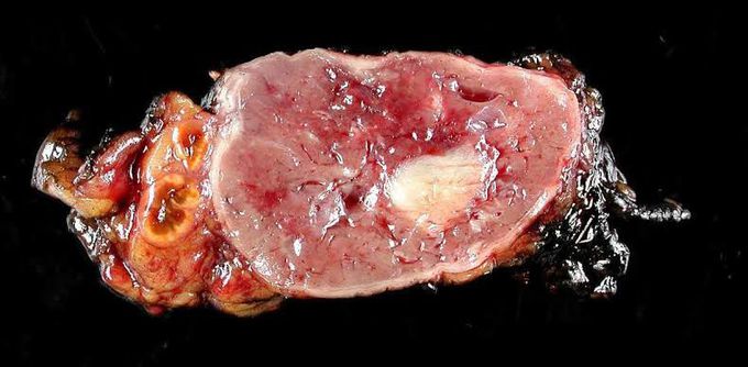 Pheochromocytoma