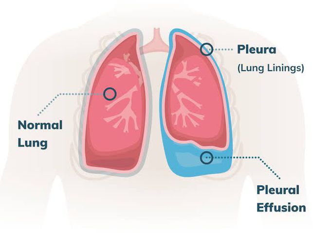 Symptoms of pleural effusion