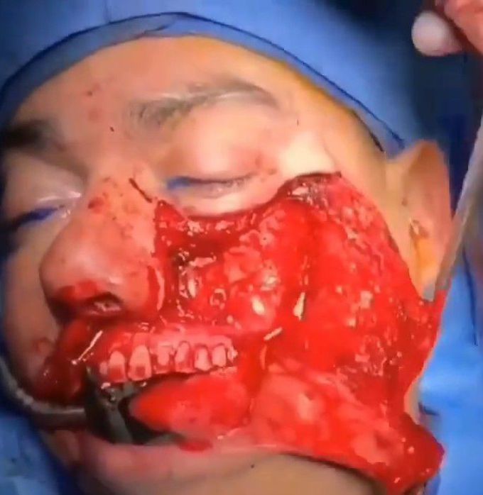 Maxillofacial Surgery