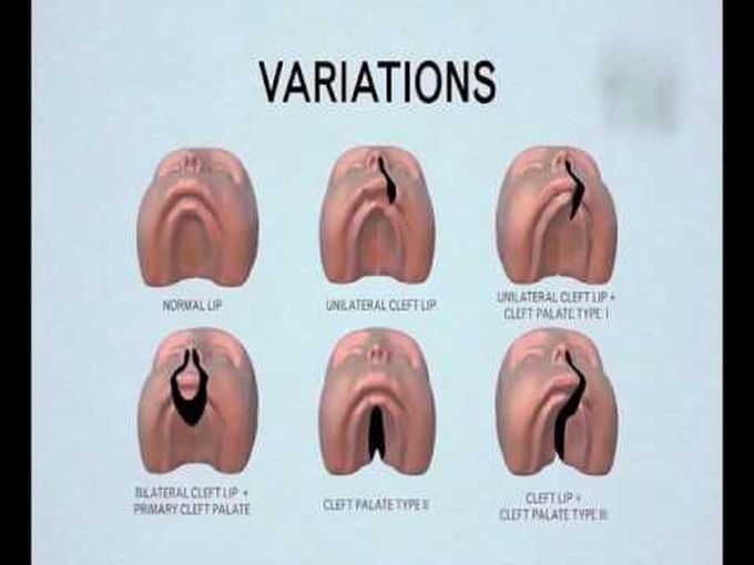 Animation - Cleft lip and cleft palate