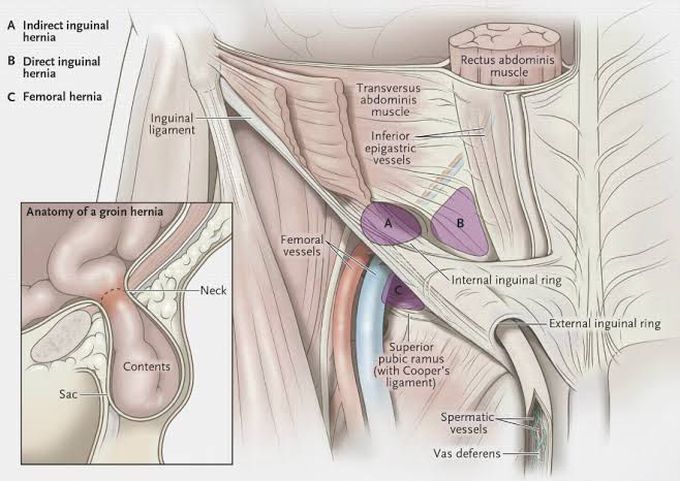 Hernia