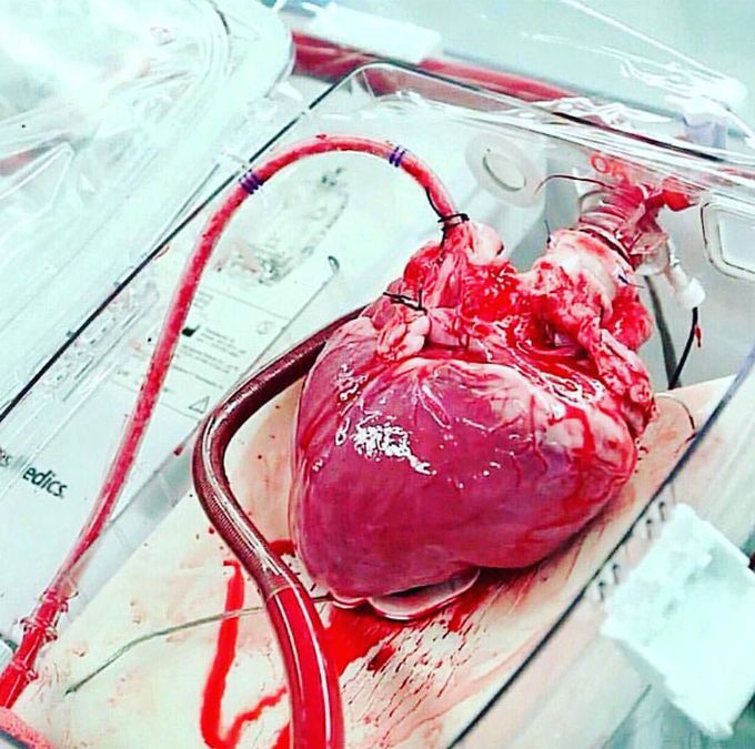 Human heart within a specialised organ care system, ready to be transplanted