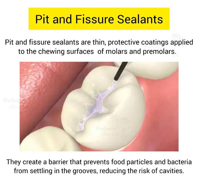 Pit and Fissure Sealants I