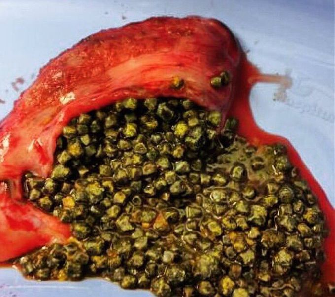 Stone in gallbladder