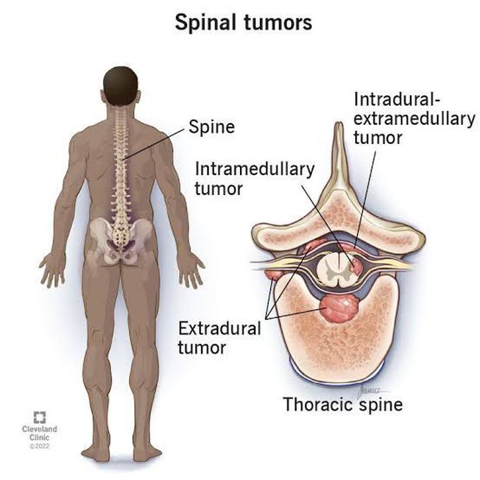 Spinal tumor