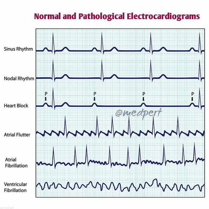 Pathological ECGs
