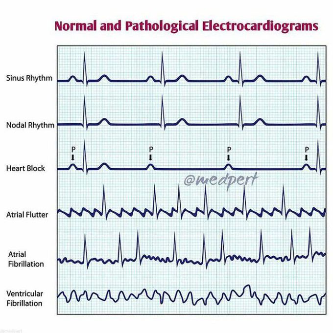 Pathological ECGs