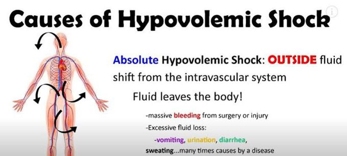 Causes of hypovolemic shock