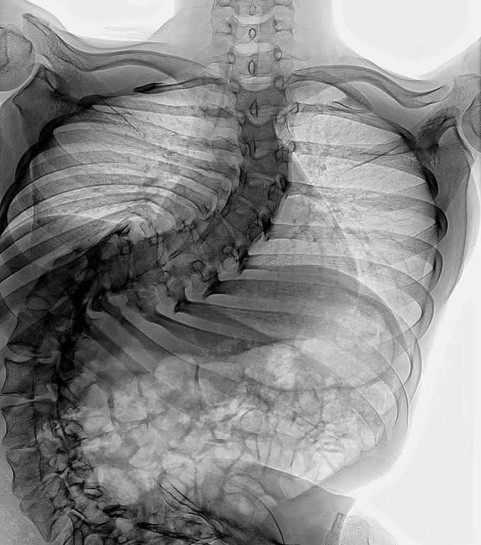 Scoliosis