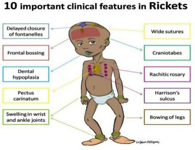 RICKETS SIGNS