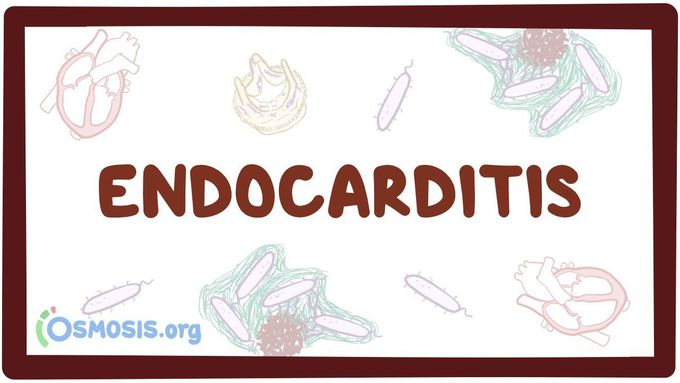 Endocarditis