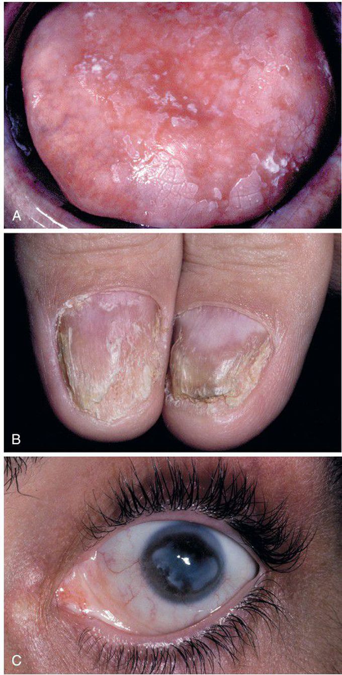 Autoimmune Polyendocrinopathy-CandidiasisEctodermal Dystrophy (APECED) Syndrome.