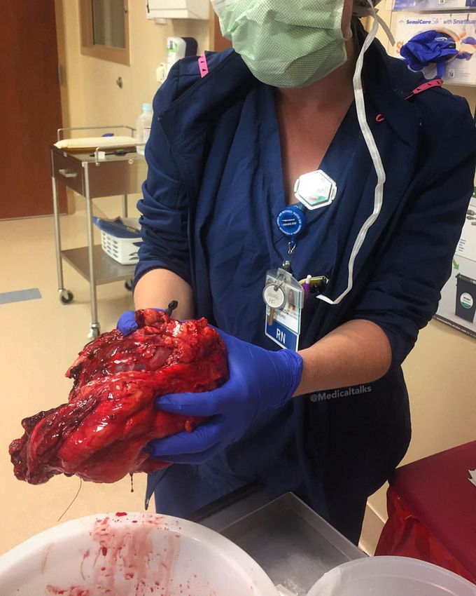 Left nephrectomy performed for a patient who had Polycystic Kidney Disease (PKD)!! 
