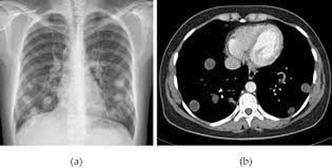 Pulmonary Hydatid Cysts