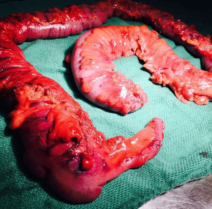 Colectomy